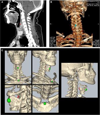 Case report: Image guidance retrieval of a foreign body in retropharyngeal space